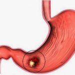 ”Tất tần tật” thông tin về căn bệnh viêm dạ dày ruột