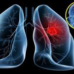 5 thói quen thường gặp khiến phổi ‘chết dần chết mòn’, nhiều người vẫn vô tư lặp lại hằng ngày